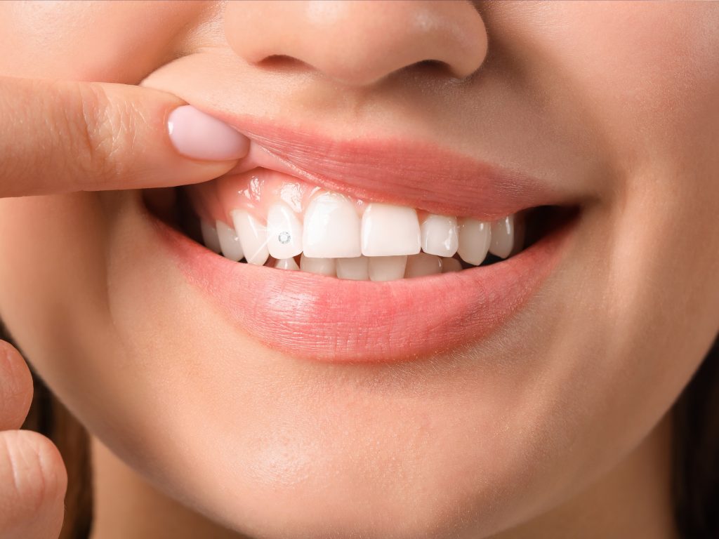 Tooth gem service in Omaha